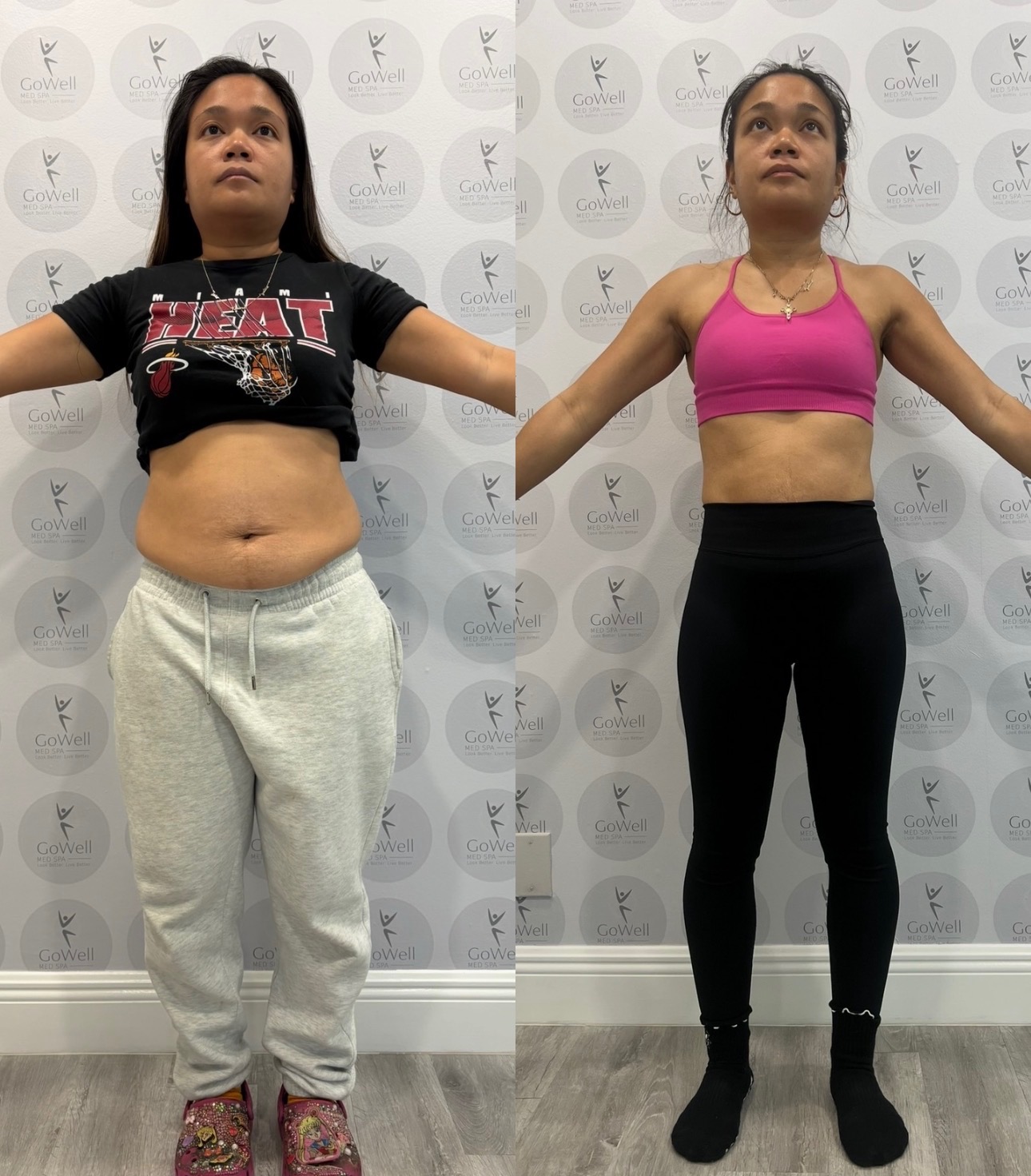 GoWell Med Spa client before and after weight loss and body sculpting — front view